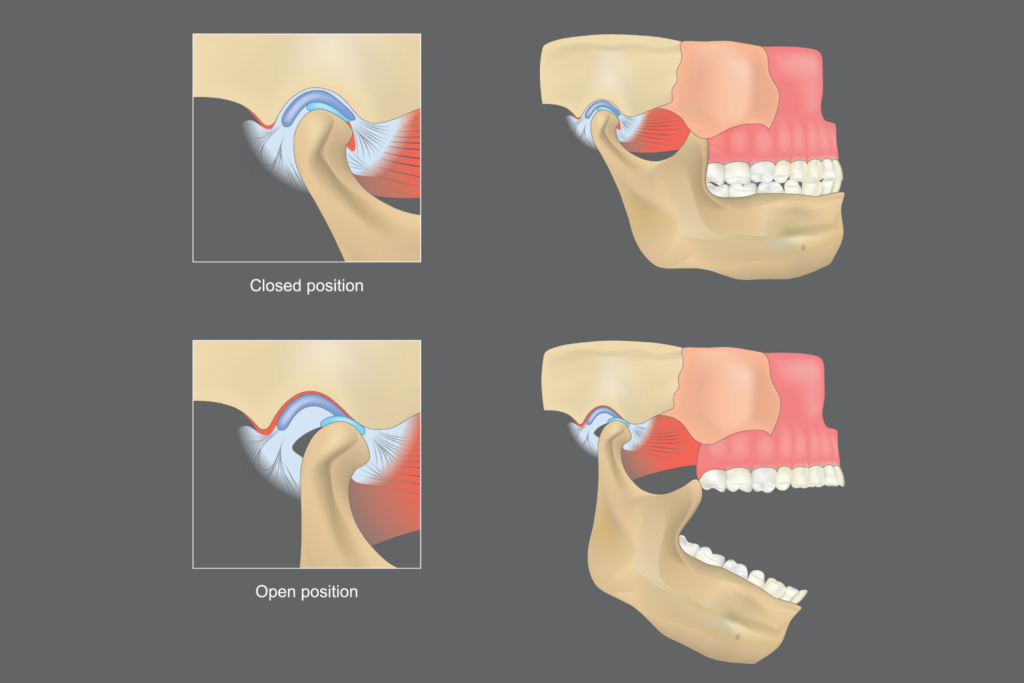 TMJ Injections - Cayman Neurology and Pain Management